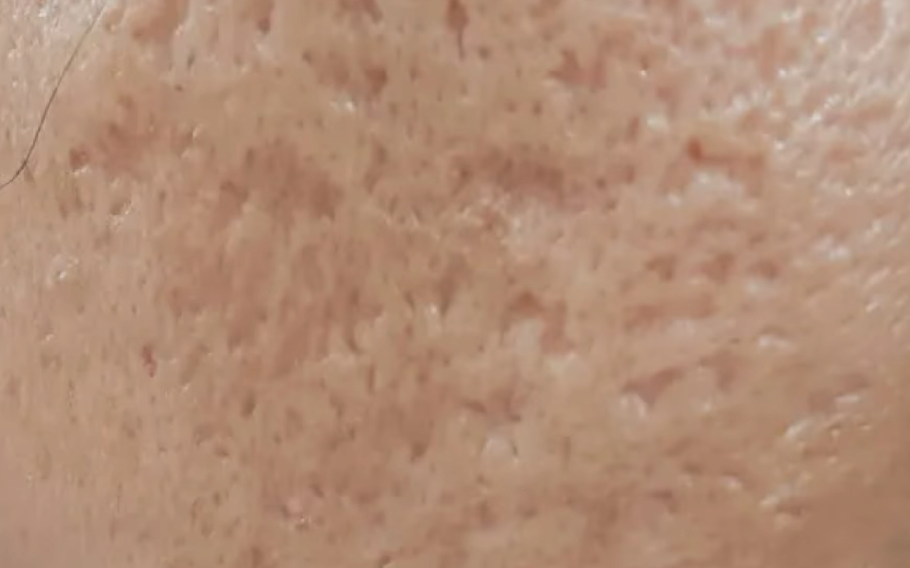 Boxcar acne scars — wide depressions with defined edges