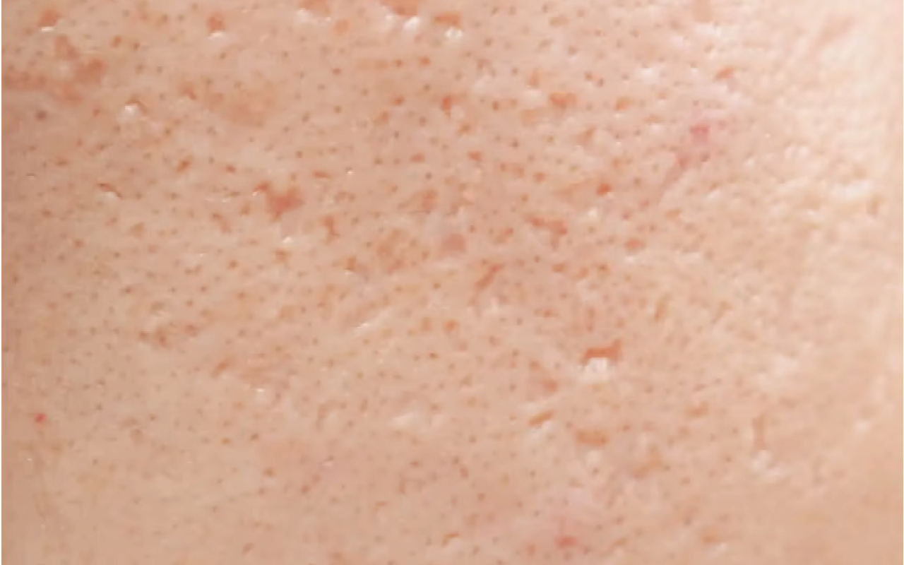 Icepick acne scars — narrow deep pits
