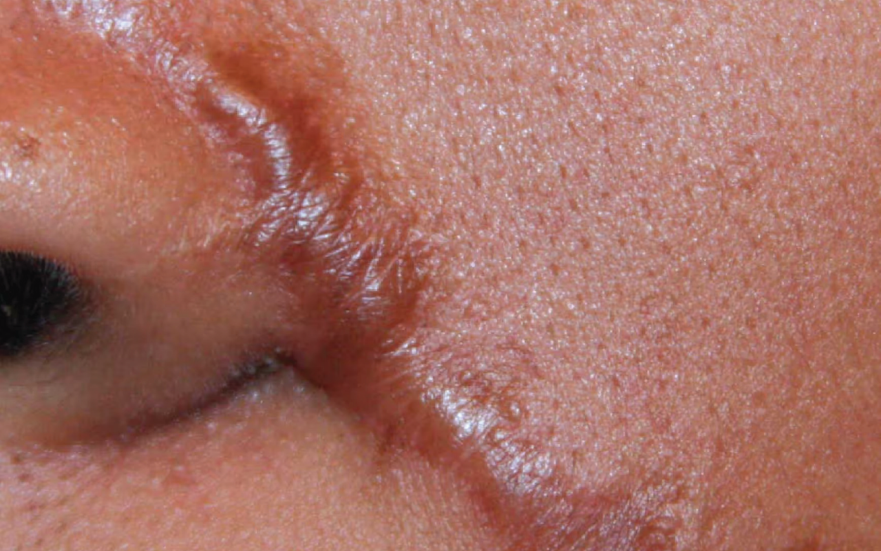 Keloid scars — raised thickened scar tissue