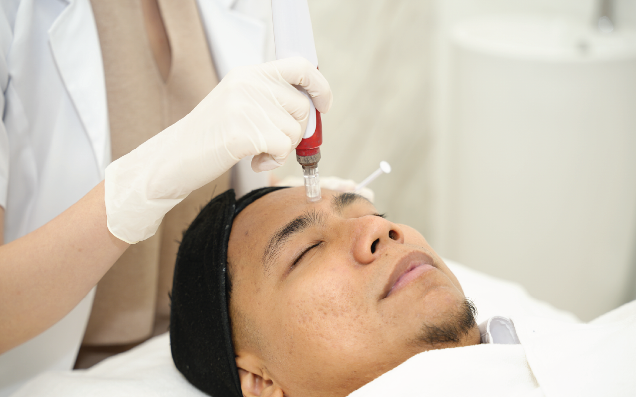 Microneedling collagen induction therapy