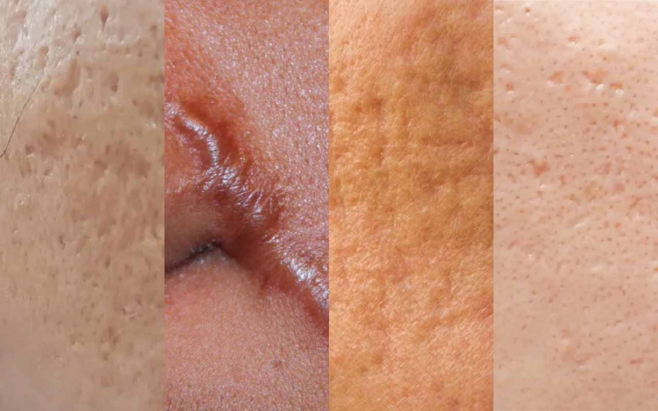 Mixed acne scars — combination of multiple scar types