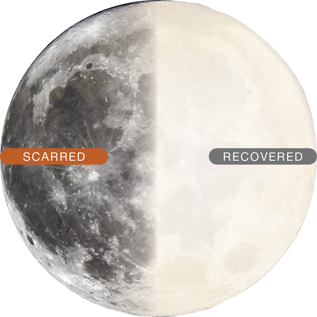 The skin's recovery, before and after the ScarAway™ Program