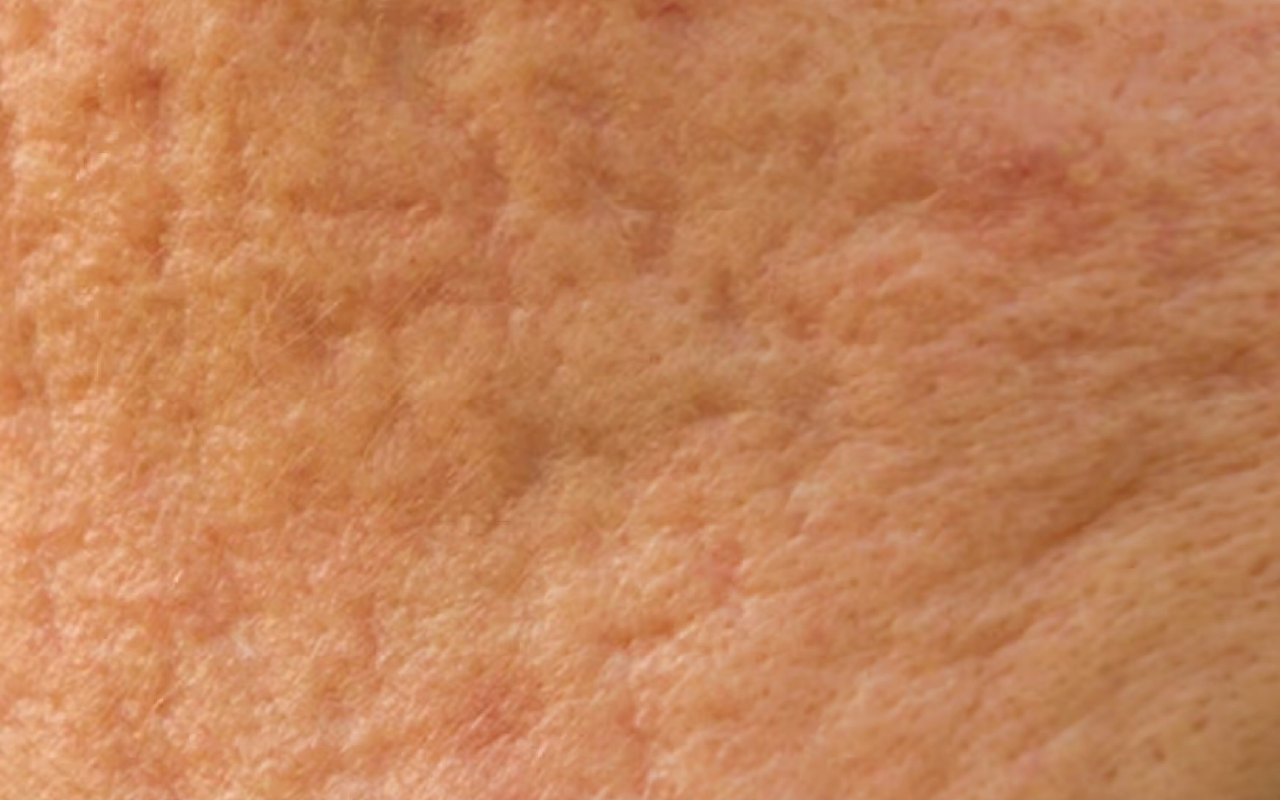 Rolling acne scars — shallow wave-like depressions