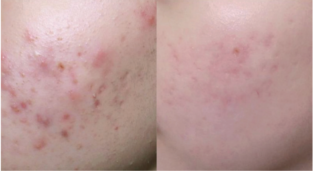 Mixed scars — before and after the ScarAway™ Program