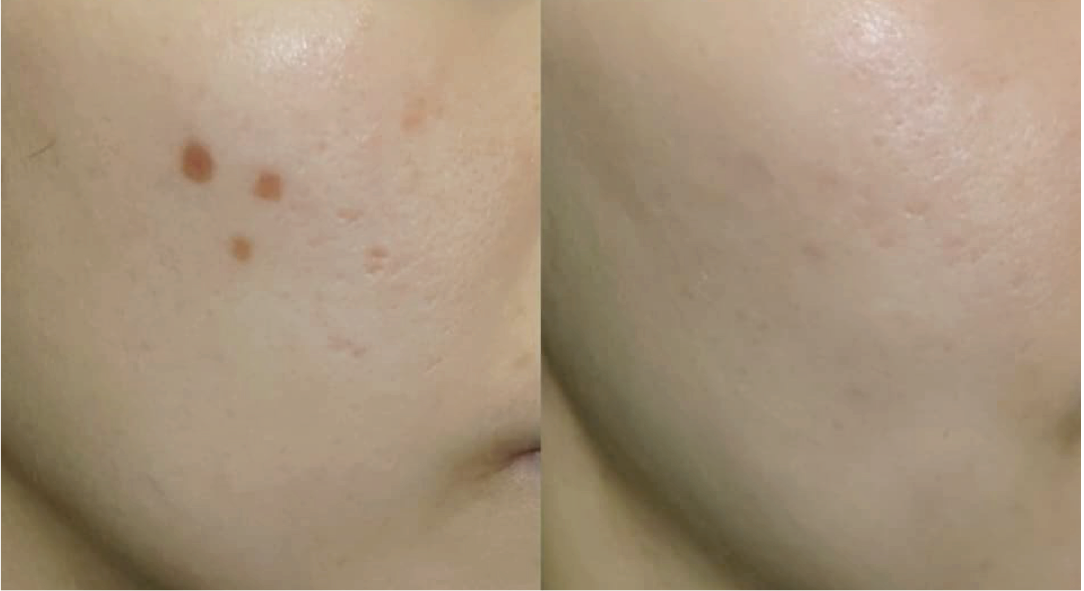Icepick scars — before and after the ScarAway™ Program