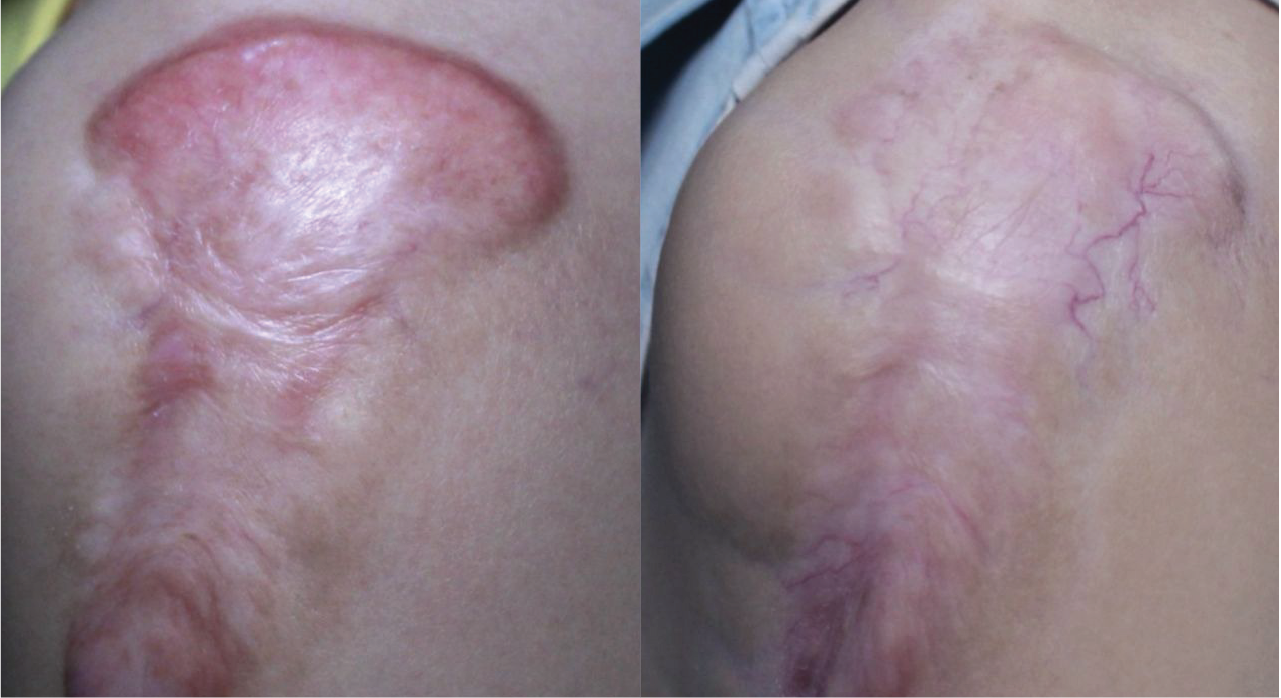 Keloid scar — before and after the ScarAway™ Program