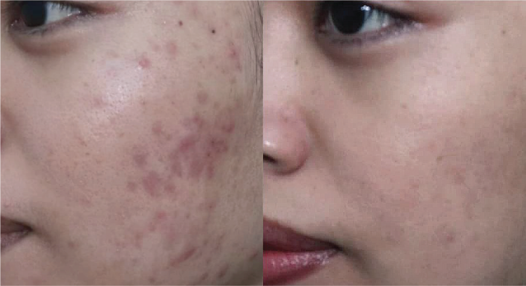 Boxcar and icepick scars — before and after the ScarAway™ Program