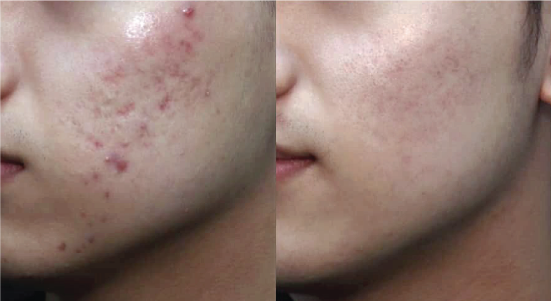 Boxcar scars — before and after the ScarAway™ Program