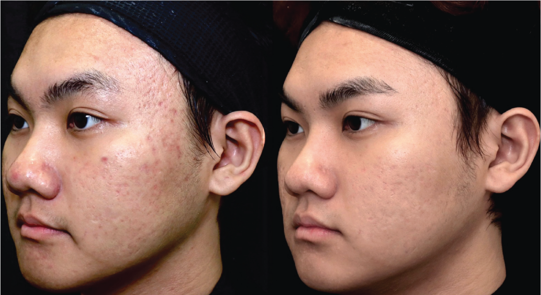 Rolling scars — before and after the ScarAway™ Program